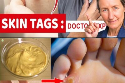 Plantar Warts and Skin Tags Disappear Naturally—Try This Overnight Remedy